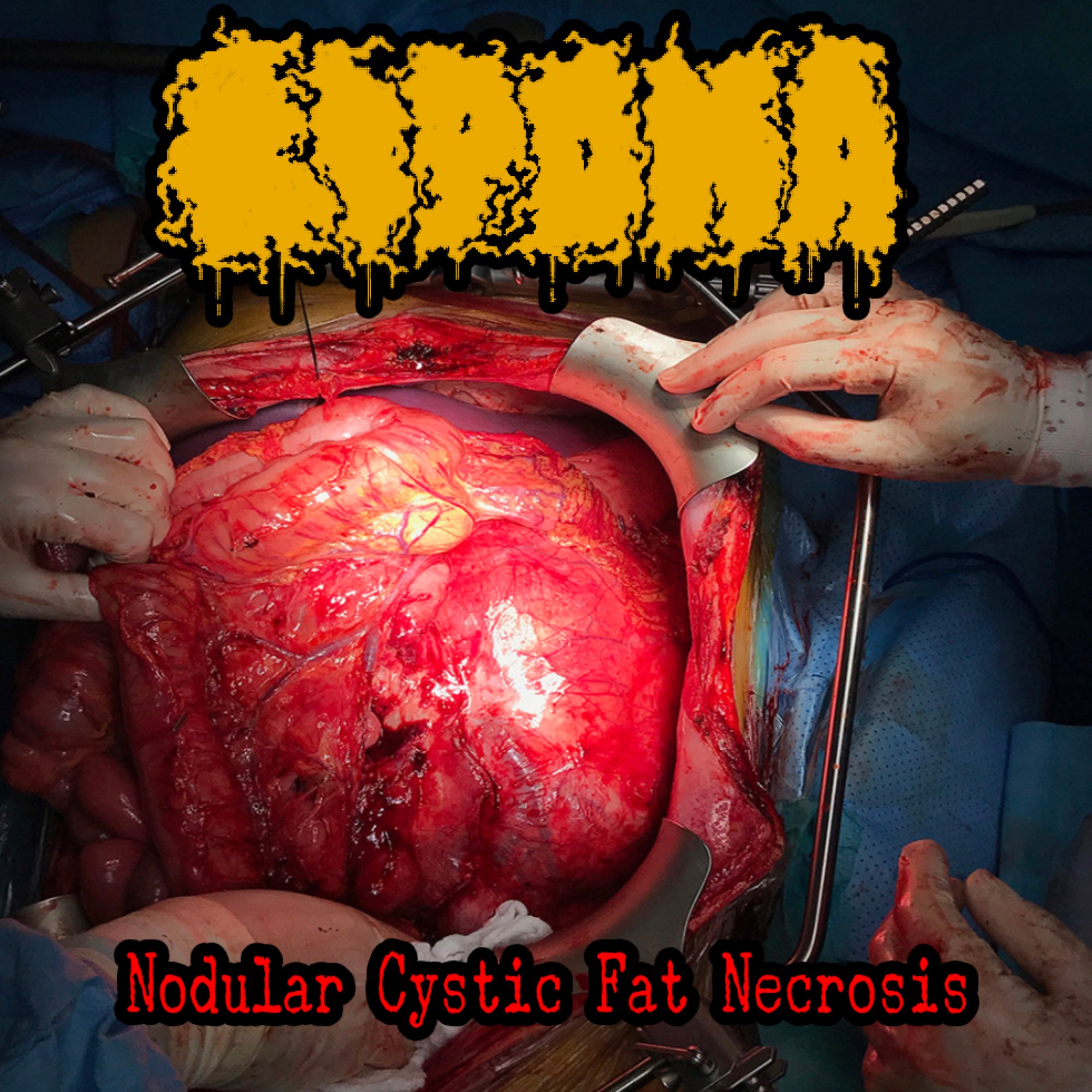 Lipoma - Nodular Cystic Fat Necrosis (2022) Goregrind